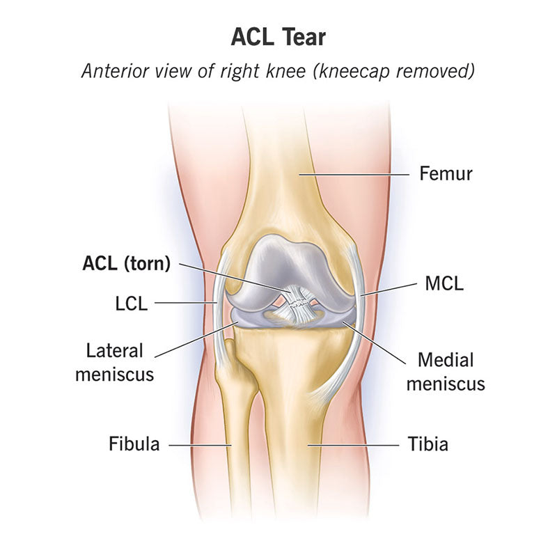 Understanding ACL Injuries in 1 min